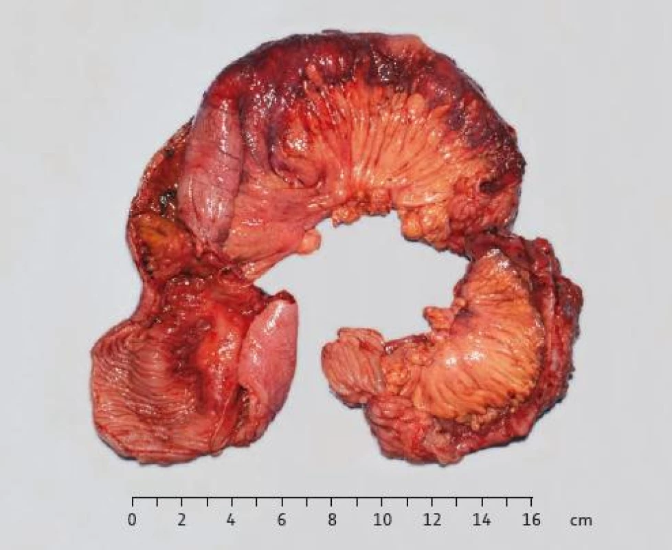 Resekát ilea: sliznice ilea s polypoidně zhrubělými řasami a stenózami.
Fig. 5. Resected ileum: polypoidal changes of ileum mucosa with stenoses.