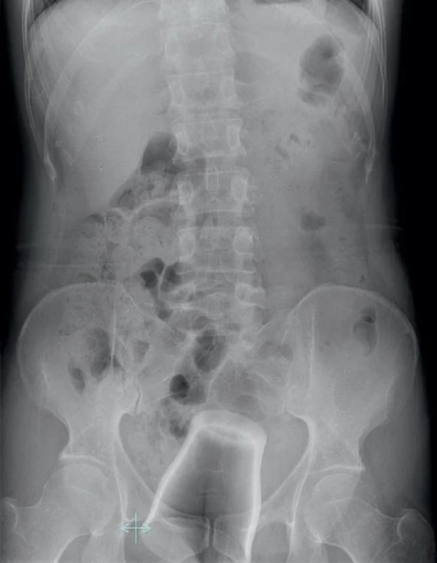  Cizí těleso v rektu, předozadní RTG snímek břicha  (vymasírováno per vias naturales z laparotomie).  Foreign body in the rectum, anteroposterior abdominal X-ray  (milked out from laparotomy through rectum).