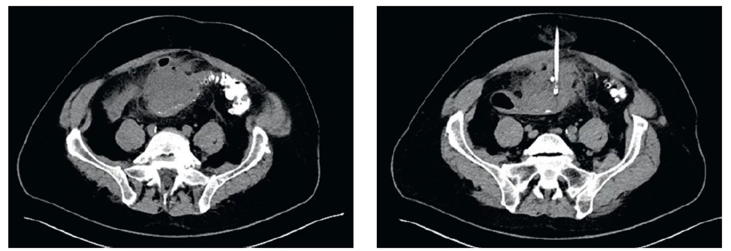 CT scan s abscesem divertikulárního původu, CT navigovaná drenáž. CT scan with abscess of diverticular origin, CT guided drainage.