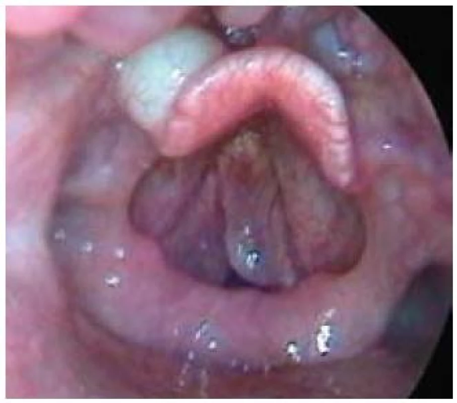 Cysta levé glossoepiglotické valekuly (kromě toho je přítomný na obou hlasivkách Reinkeho edém).
Fig. 9. Cyst of the left glossoepiglottic vallecula (Reinke’s oedema of both vocal cords is also present).