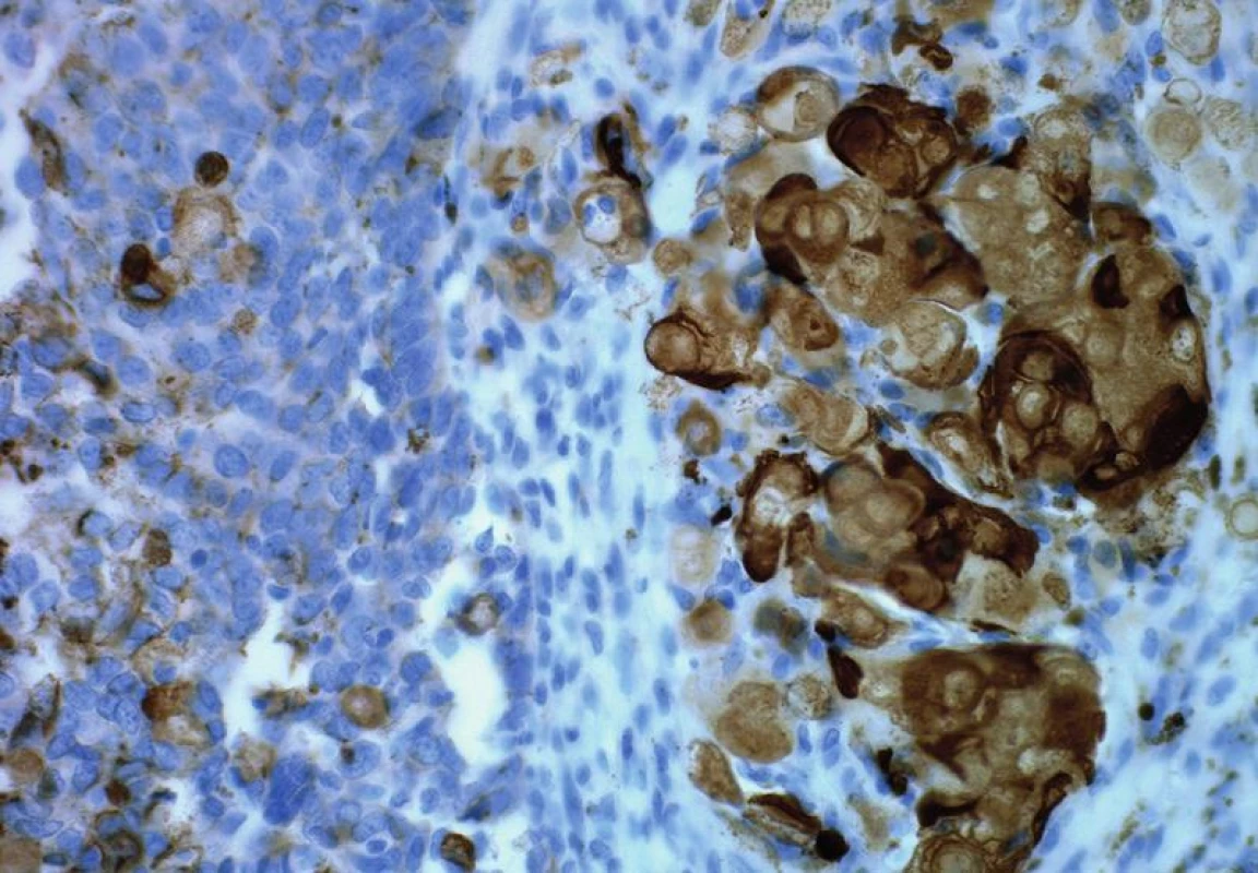 Silná exprese koktejlu cytokeratinů (AE1/AE3) ve stínovitých buňkách (vpravo) a slabá pozitivita téhož markeru v matrikálních buňkách (vlevo) (HE, původní zvětšení 400x).