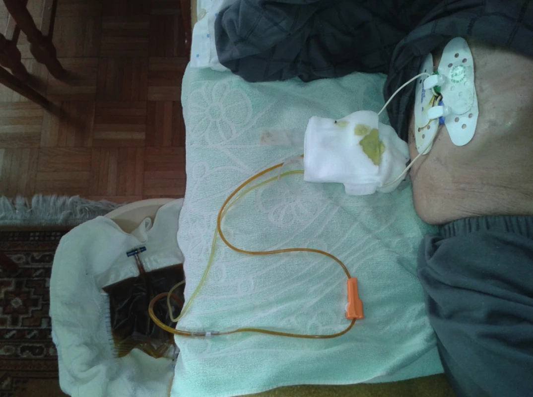 Obtekanie PTD katétra vyžaduje časté preväzy miesta výstupu katétra
Fig. 12: Leak of the PTD catheter requires frequent redressing of the wound