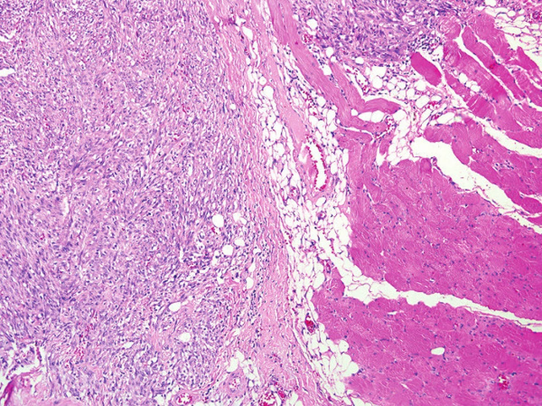 Struktury leiomyosarkomu s invazí do tukové a svalové tkáně (pravá polovina fotky) Hematoxylin-eosin, zvětšení 100x.
Fig. 1: Structures of leiomyosarcoma invading the fatty and muscle tissue (the right half of the photograph). Hematoxylin-Eosin, 100x magnification.