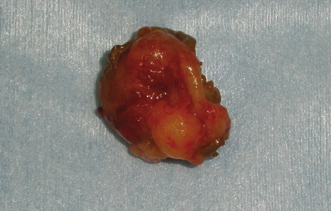 Exstirpovaný tumor
Fig. 4: Removed tumour