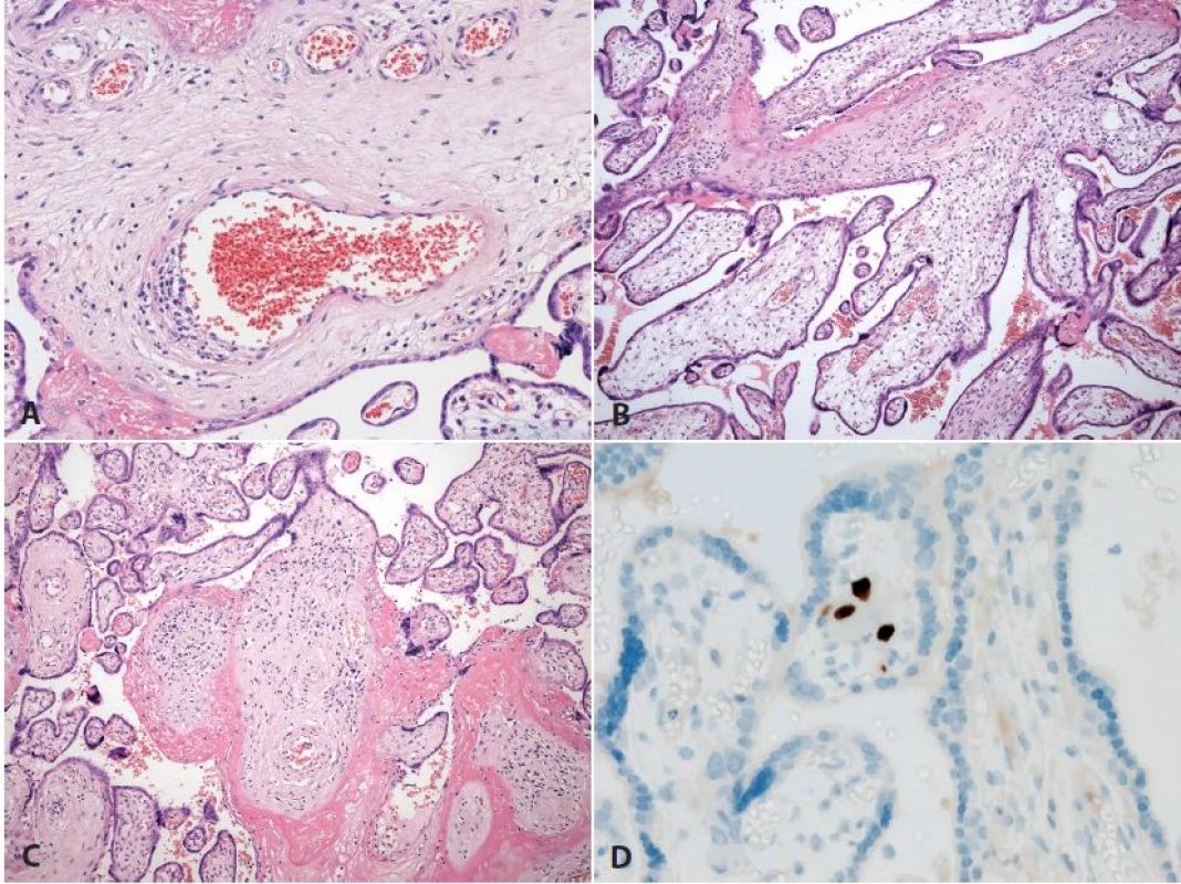 <b>Vilitida</b>. Placenta ze 36. týdne gravidity, vrozená cytomegalovirová infekce plodu (plod vitální, dle klin. údajů těžce postižený). <b>A</b>: postižení cévních struktur zánětem (HE, zvětš. 200x). <b>B, C</b>: různá intenzita zánětlivých změn klků, v <b>C</b> již fibrotizace (HE, zvětš. 100x). D: imunohistochemický průkaz cytomegaloviru (zvětš. 400x).