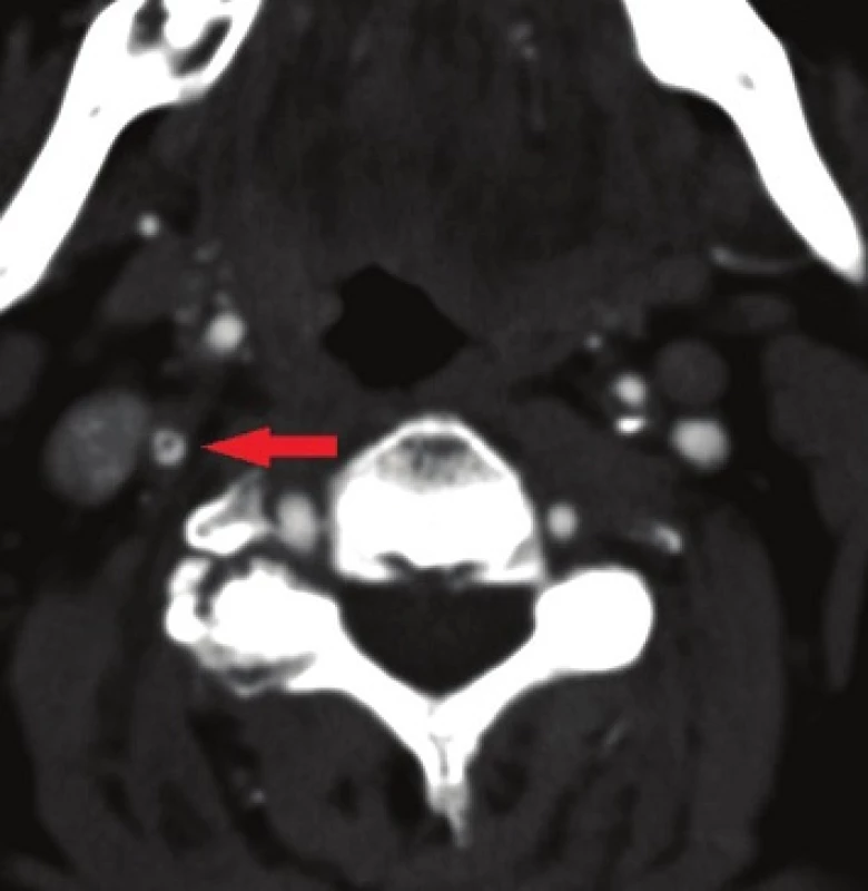 Volně vlající trombus ve vnitřní karotidě
Fig. 2: Free-floating thrombus in the internal carotid artery
