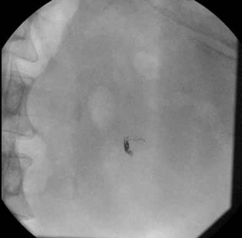 RTG – spirálky uložené do tepny
Fig. 3. X-ray – coils in artery