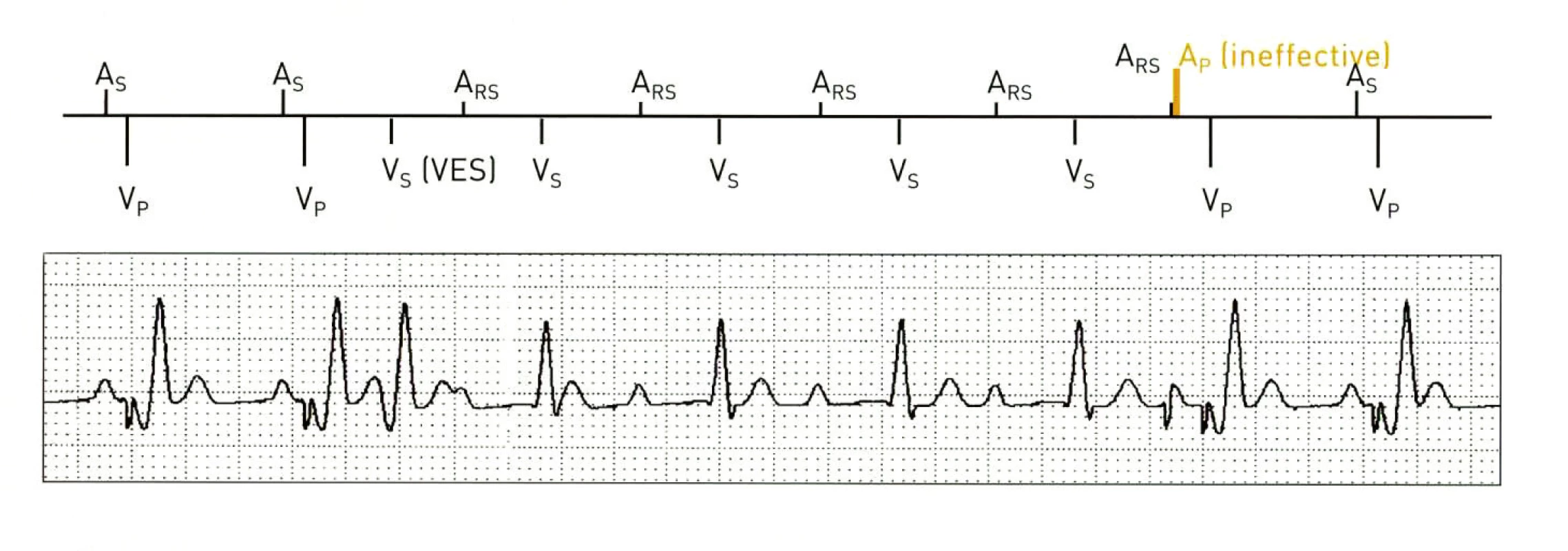 VES Locked In neboli funkční atriální undersensing. Vlastní sinusový stah spadající do doby atriální refrakterní periody (ARP) v důsledku např. předchozí komorové extrasystoly (VES) nespouští AV-zpoždění. Spontánně převedený komorový stah je hodnocen jako VES (komorová extrasystola) a je následován prodloužením ARP. Bez intervence PM či terminující situace (např. extrasystola) se stav udržuje. Funkce VES Locked In Protection situaci dokáže detekovat a terminovat. (zdroj: Biotronik Philos II. Výukový materiál)