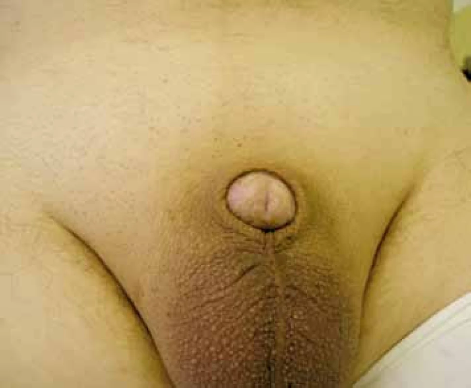 U obézních pacientů dochází i po provedení circumcise k zanoření penisu a přetrvávání vhodných podmínek pro další progresi BXO 
Fig. 2. Circumcision in obese patients may lead to buried penis and keep convenient environment for BXO progression