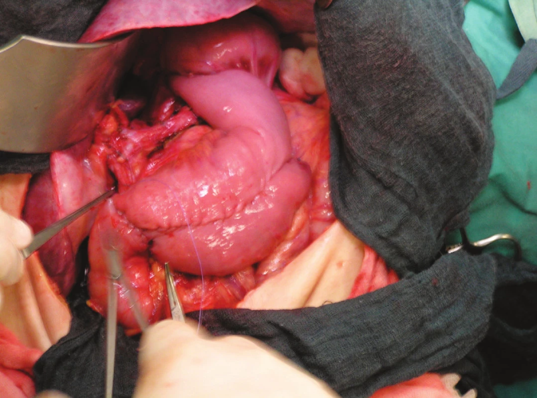 Peroperační snímek – J-pouch s antirefluxní manžetou
Pic. 2. Intra-operative picture – we create J- pouch with antireflux cuff