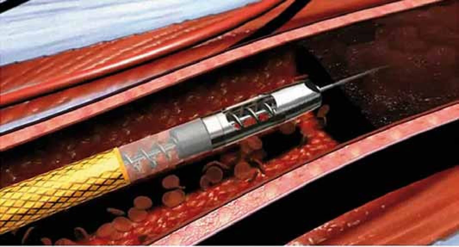 Detail pracovního konce systému Rotarex<sup>®</sup> k mechanické rekanalizaci akutních a subakutních tepenných uzávěrů.