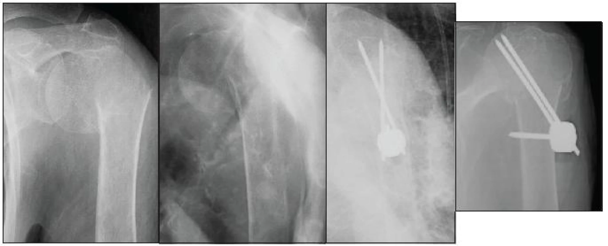 Osteosyntéza podle Resche u 83leté pacientky s dislokovanou zlomeninou horního konce pažní kosti