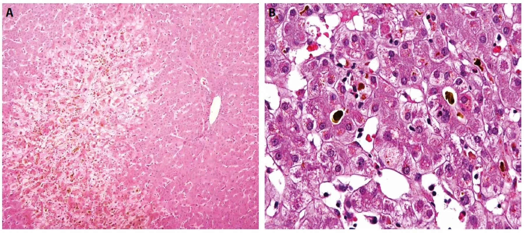 Akutní cholestáza. Centrolobulární akcentace cholestatických změn. Barveno hematoxylinem eozinem (A, zvětšení 100x). Hepatokanalikulární bilirubinostáza a cholestatické rozety. Barveno hematoxylinem eozinem (B, zvětšení 400x).