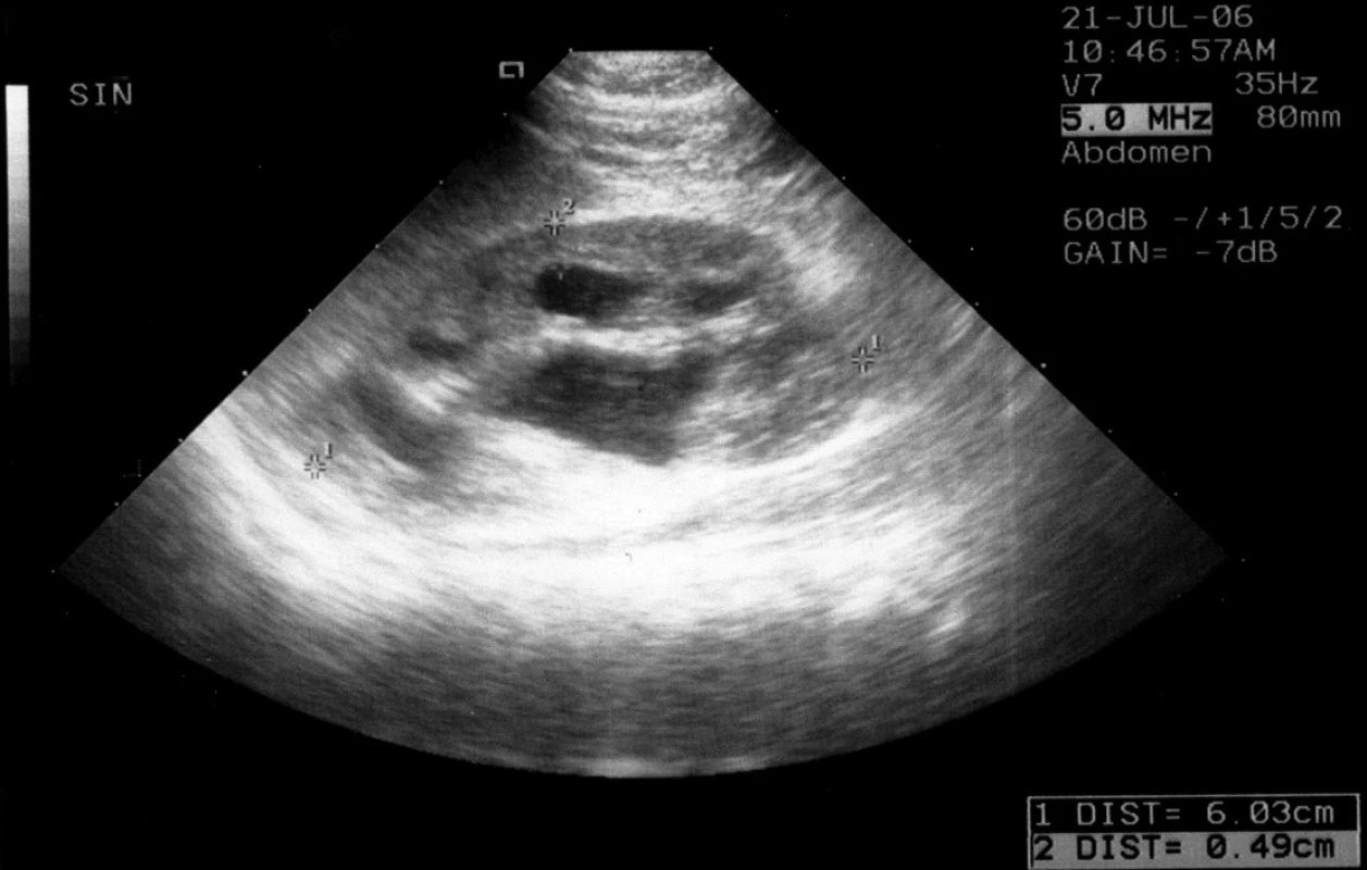 Kazuistika č. 1. UZ levé ledviny 8. den po pyeloplastice: Ústup dilatace KPS a nárust šíře parenchymu. Ledvina dlouhá 6 cm, pánvička APIR 10 mm, horní kalich rozšířený na 10 mm, parenchym je hyperechogenní, nepravidelně redukovaný – v nej užším místě nad horním kalichem šíře 2 mm, ale v ostatních částech je šíře 4–5 mm.
Fig. 2. Case report 1. US of the left kidney on day 8 after pyelopasty: waning dilatation of calix-pelvic system of the left kidney and increased width of parenchyma. The in 6 cm long, pelvis APIR is 10 mm, upper calyx is extended to 10 mm, parenchyma is hyperechogenic, irregularly reduced – in the mot narrow place above the upper calyx there is 2 mm width, but in the other part the width is 4 to 5 mm.