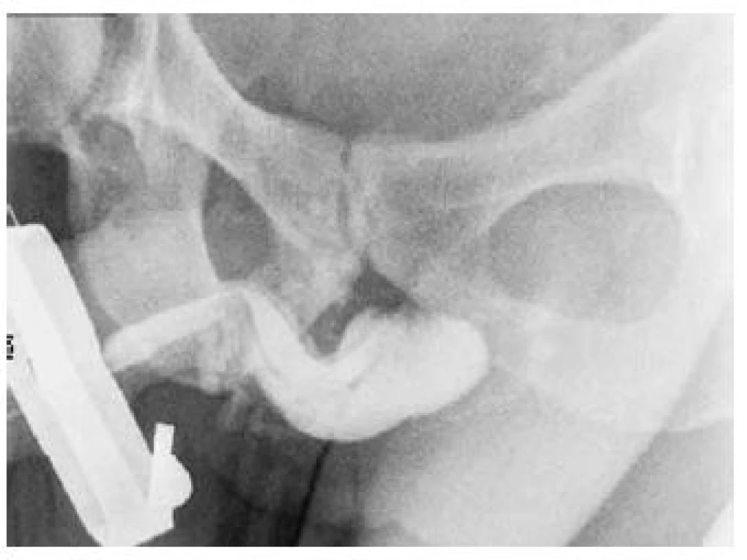 Ascendentní uretrografie – kompletní ruptura zadní uretry (kontrastní látka uniká do parauretrálního prostoru)
Fig. 6. Ascendent urethrography – complete rupture of the posterior urethra (the contrast substance escapes outside the lumen of the urethra)