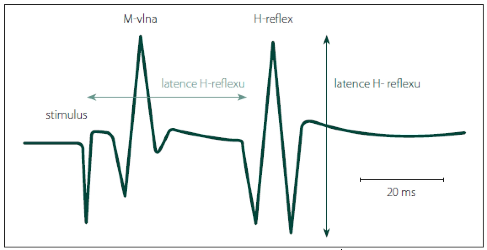 Latence se měří od začátku stimulu k první pozitivní odchylce křivky H-reflexu od základní linie, ne od začátku první negativity.
Fig. 2. The latency is measured from the beginning of the stimulus until the first deviation of the H-reflex curve from the base line, not from the start of the first negativity.