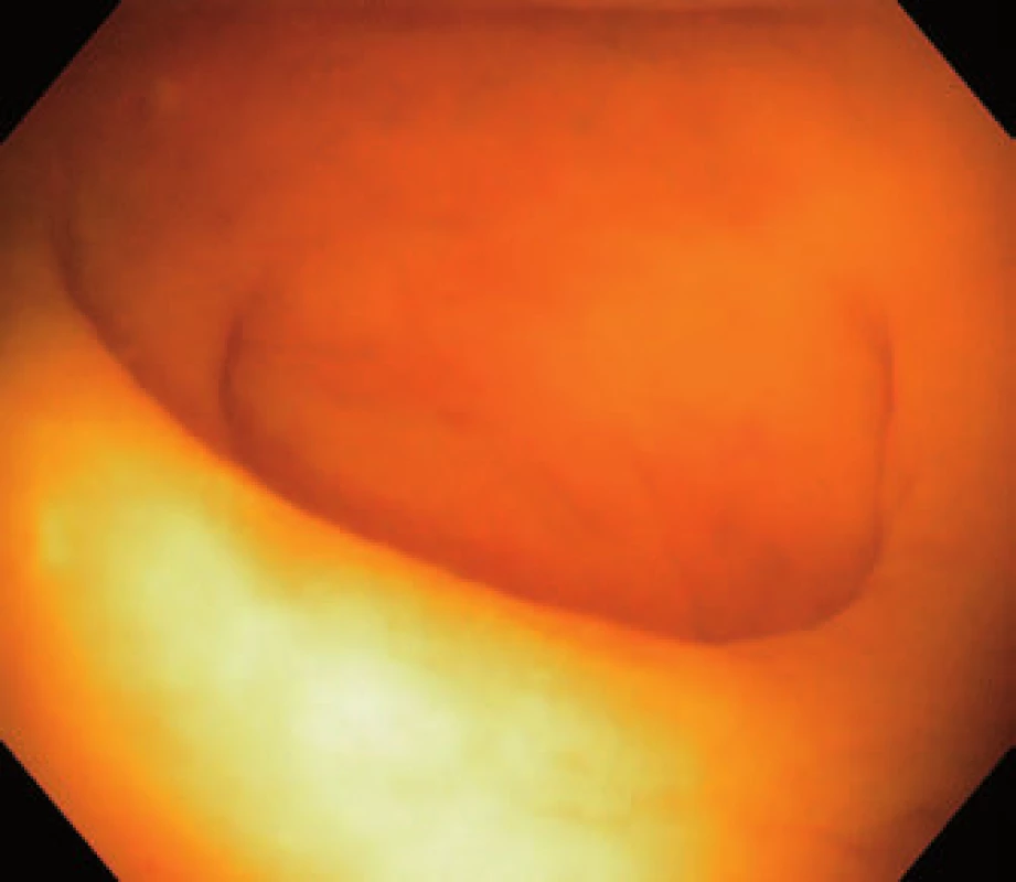 Ústí appendixu ve vodní imerzi.
Fig. 2. Appendiceal orifice in water immersion.