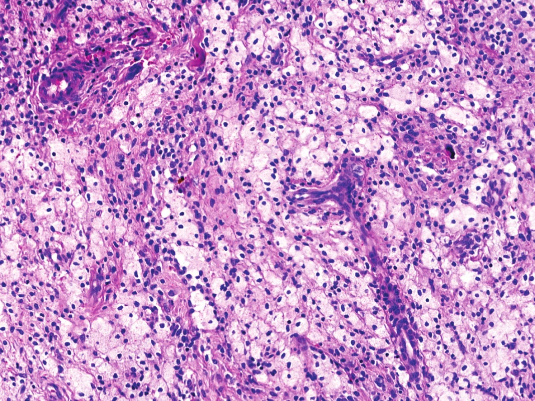 Mapovité xantogranulomatózní pasáže dotvářely celkovou kompozici léze (HE, 200x).