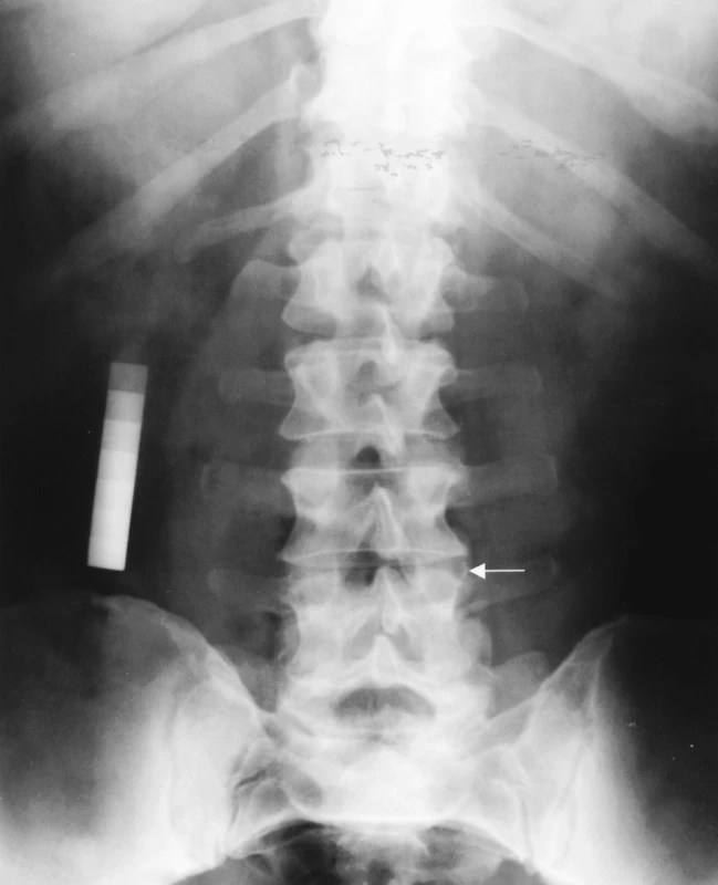 Fluoróza II. štádium a spondylartrotické zmeny lumbálnej chrbtice
Ossifikácie lig. longitudinale anterior.