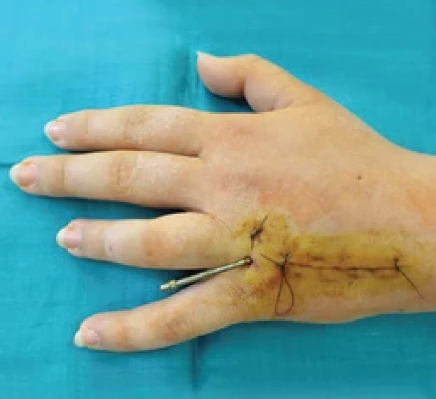 X-ray at the end of distraction phase showing achieved length and device in position.