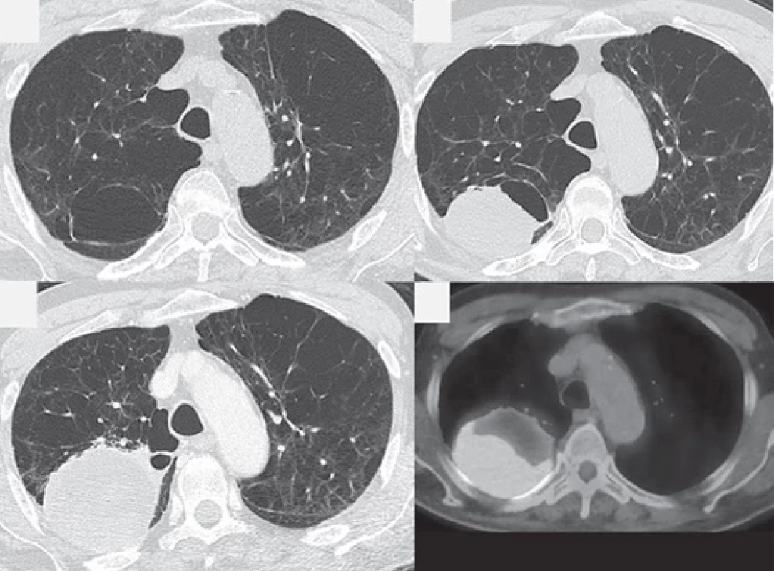 A CT scan taken 12 months before the nodule of the right lung was discovered showed no nodule in the right upper lobe of
the lung (A). CT scan taken 9 weeks after the nodule revealed a mass measuring 89 × 60 mm in the upper right lobe that was presumably
arising from the cyst wall (B). Further growth of the tumor was observed in a CT scan taken 11 weeks after the nodule was
discovered (C).