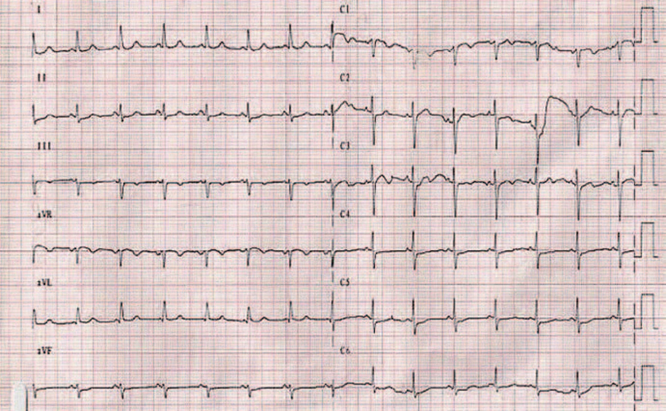 EKG záznam 5 dní po liečbe.