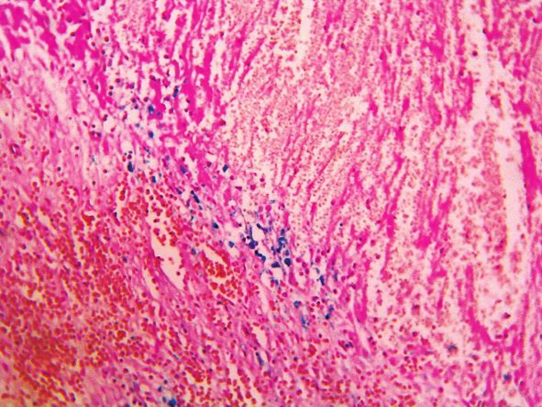 Prejavy staršieho krvácania v slezine v zmysle prítomnosti hemosiderínu. Farbenie na železo (zväčšenie 200x).