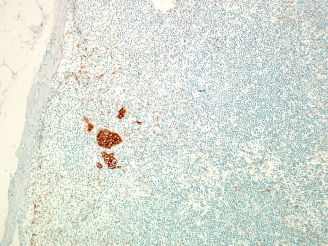 Mikro- a submikrometastázy karcinomu prsu, zobrazeny imunohistochemicky
Fig. 2. Micro- and submicrometastases of the breast carcinoma, on immunohistochemistry