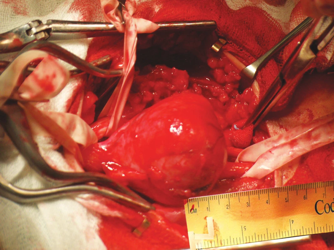 Schwannom peroneálního nervu
Fig. 1. Schwannoma of the peroneal nerve