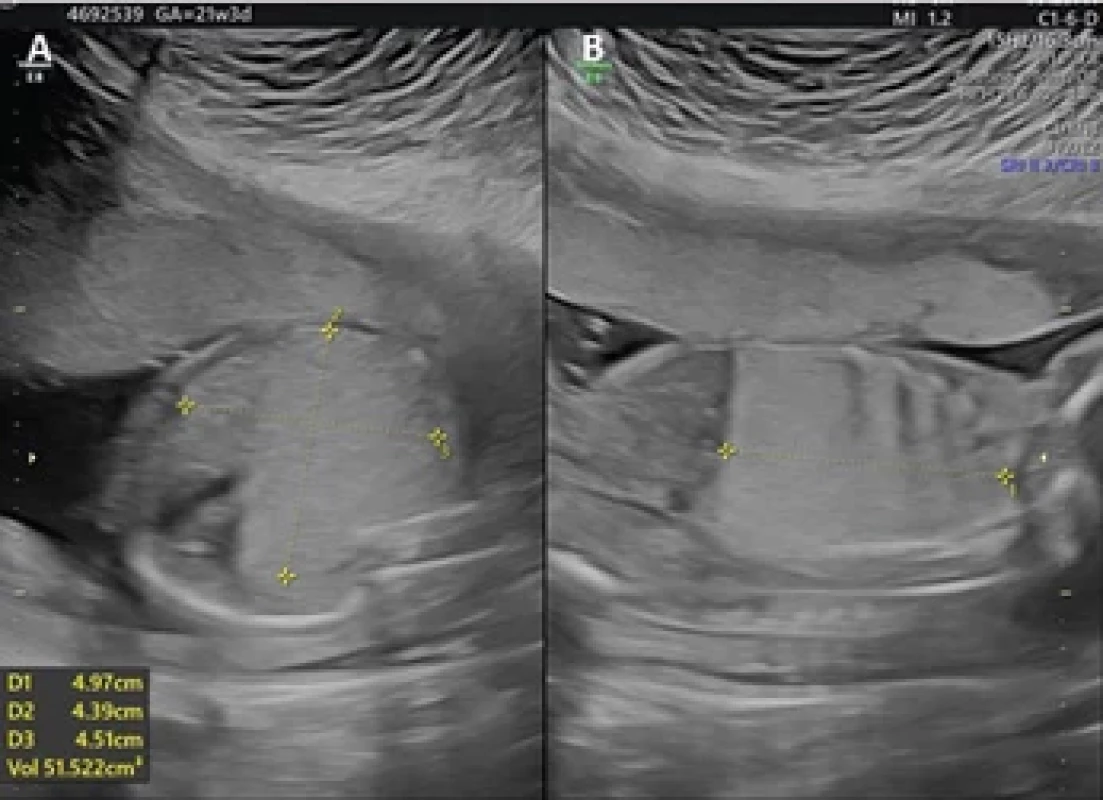 Obstetrical ultrasound at thorax level in axial (A) and sagittal (B) views at 21 weeks of gestation showing the congenital cystic adenomatoid malformation volume calculation.