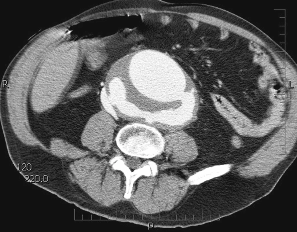 CTA prokázána ruptura velkého aneuryzmatu břišní aorty do dolní duté žíly.
Fig. 1. CTA demonstrated a rupture of a large abdominal aortic aneurysm into the inferior vena cava.