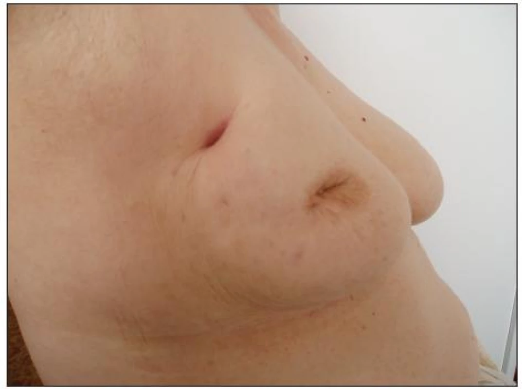 Exulcerovaný tumor
Fig. 5. Exulcerated tumor