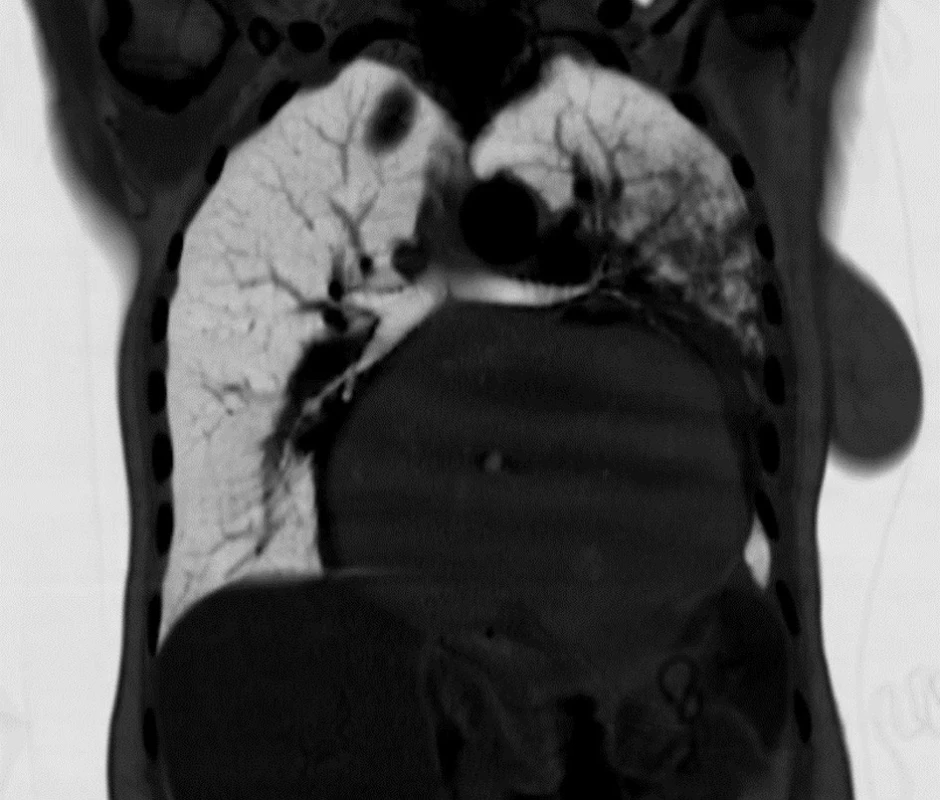 Frontální snímek CT (negativ)
Fig. 11: Frontal CT image (inverse)