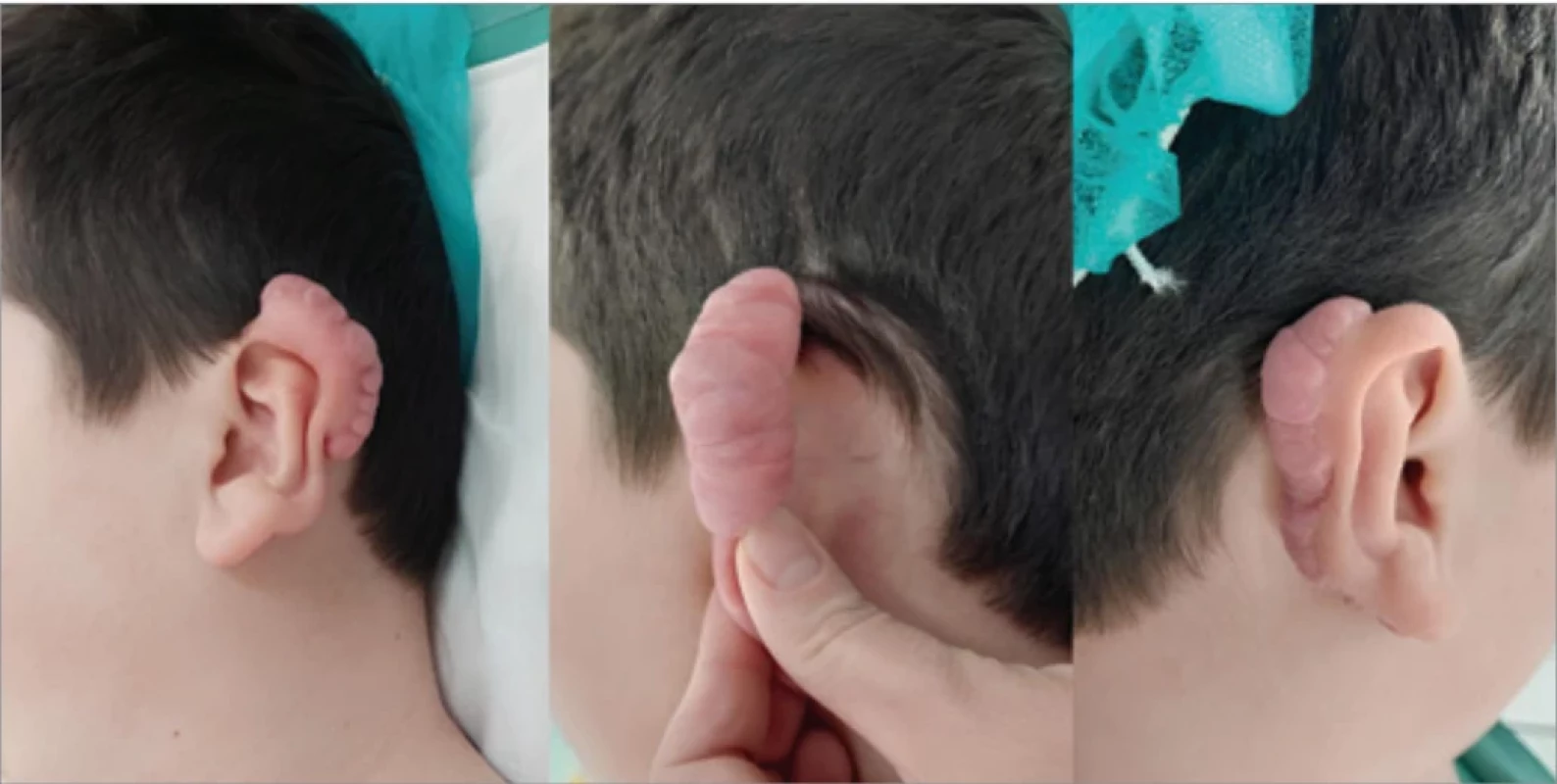  Patient 2 – preoperative keloid formation observed on both ears.
