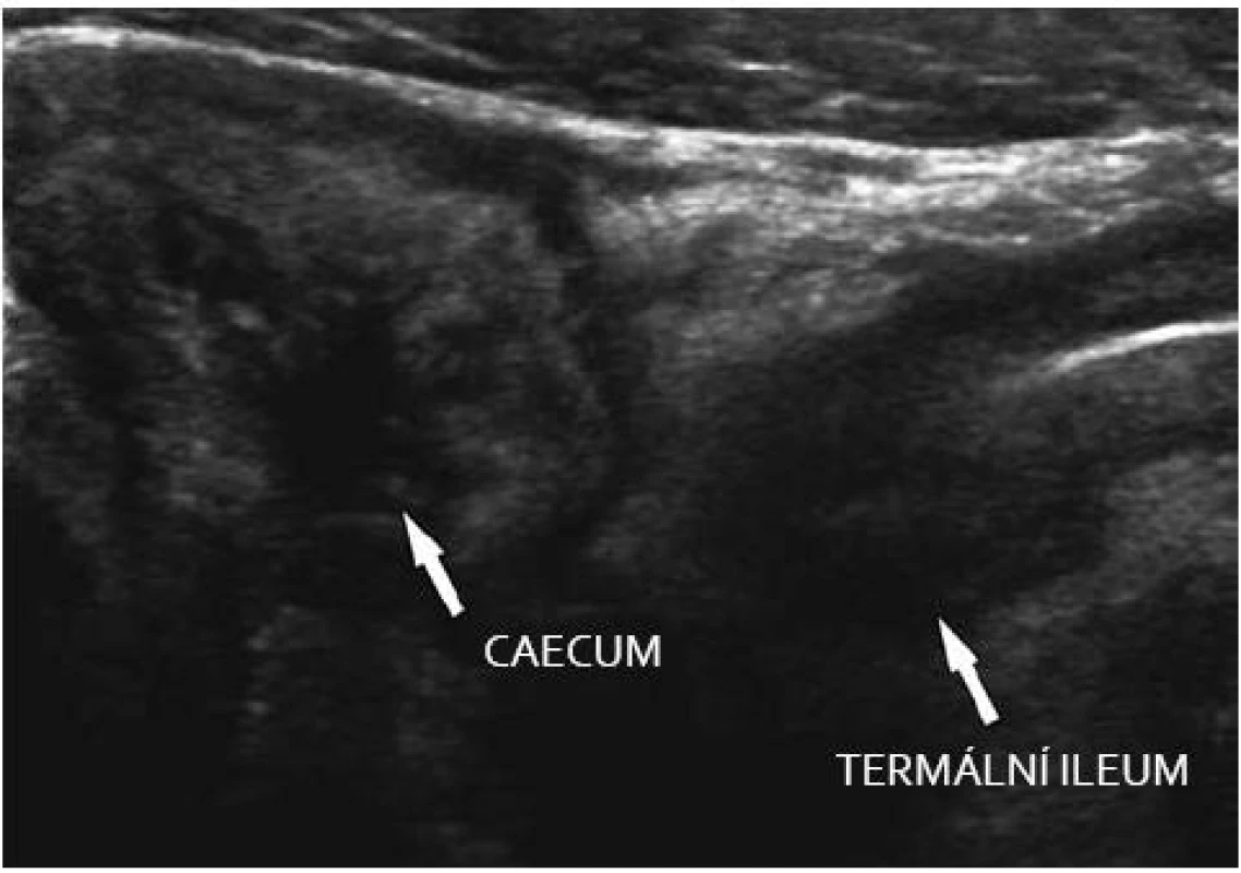 M. Crohn – chronické změny v oblasti ileocaeka.
Fig. 4. M. Crohn – chronic changes in the ileo-caecal region.
