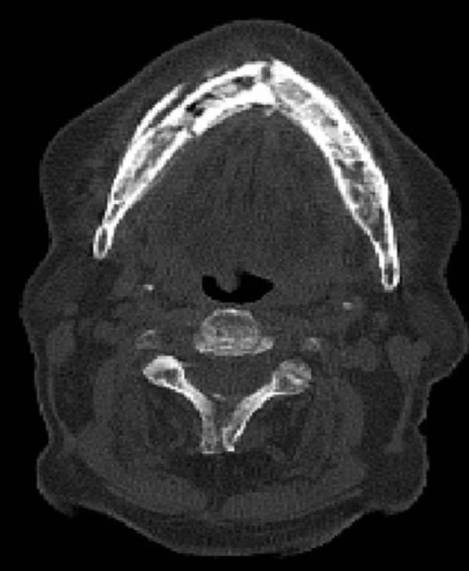 Nízkodávkové nativní CT v rámci SPECT/CT vyšetření u pacienta z obr. 1, axiální řez – nehomogenní struktura celé dolní čelisti se sklerotickými okrsky, osifikovaná periostální reakce na zevní i vnitřní ploše mandibuly. Oproti OPG jsou patrné 2 lomné linie – v symfýze a v těle mandibuly vpravo ad 45. (Zdroj obr.: Klinika zobrazovacích metod LF UK a FN
Plzeň)