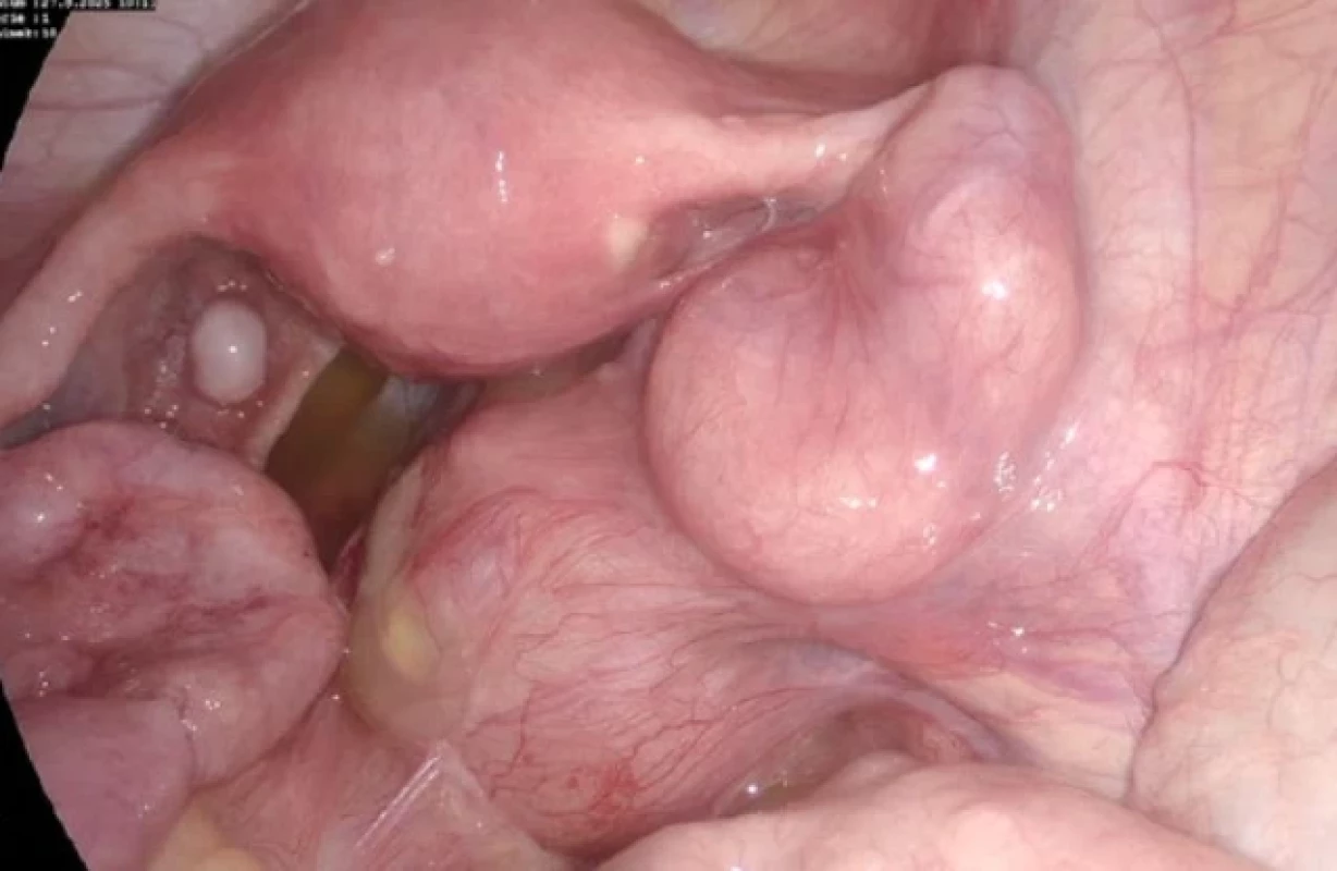 Laparoskopie – pyosalpinx. Laparoscopy – pyosalpinx.