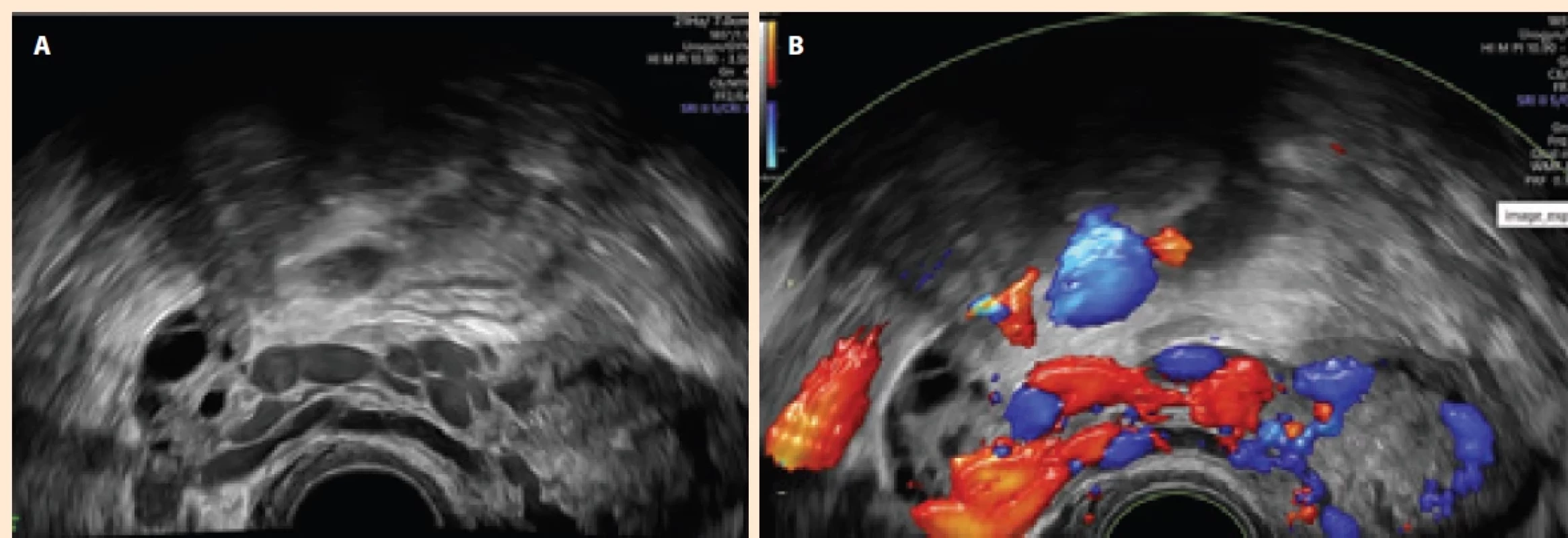 UZ Obraz pánevní kongesce. A) Obraz. B) Barevné dopplerovské zobrazení. Fig. 4. US image of pelvic congestion. A) Image. B) Color Doppler imaging.