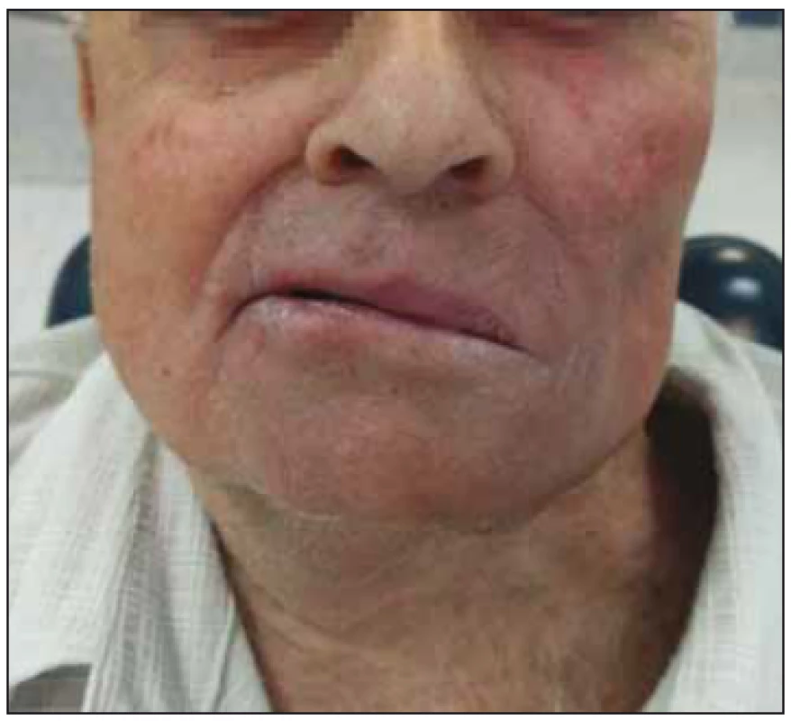 Výsledek operace (po 5 měsících)
(pacient č. 1).<br>
Fig. 5. Postoperative result (5 months after
surgery) (patient No. 1).