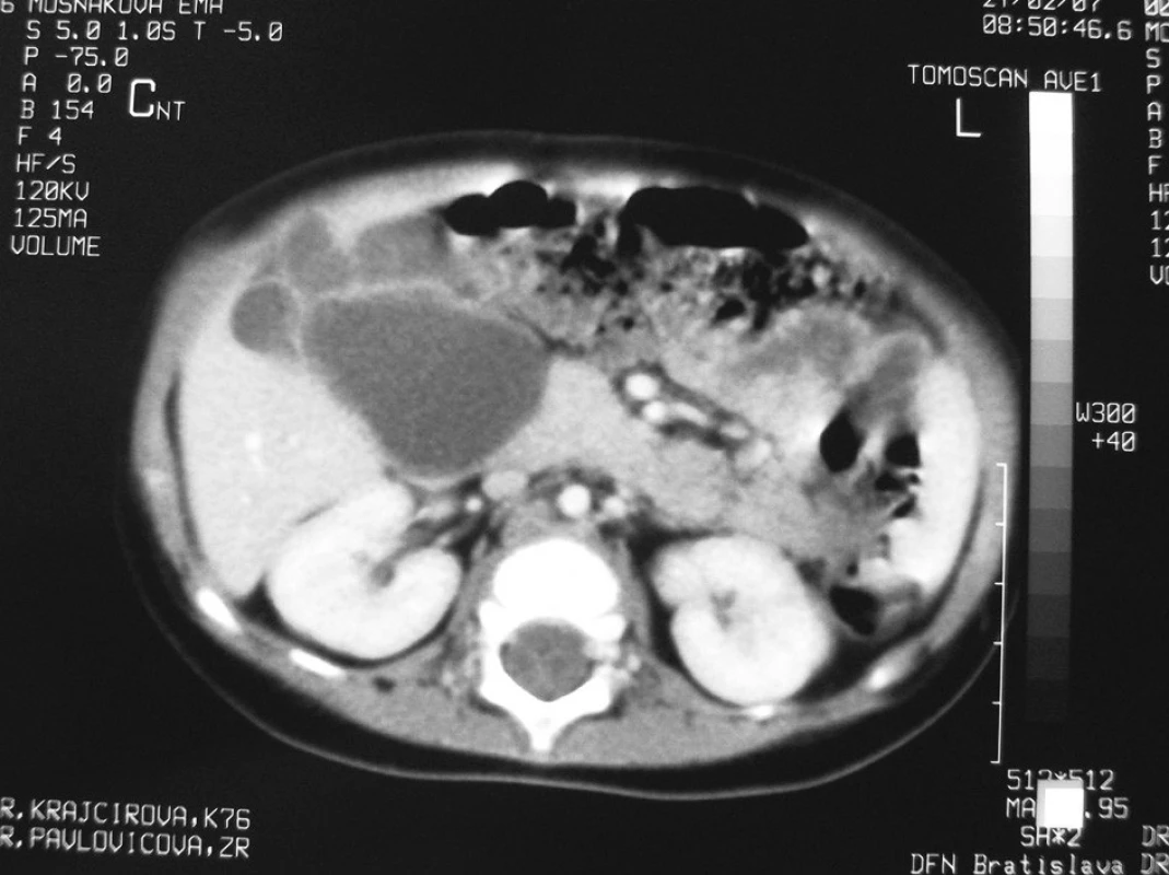 CT – multicystické ložiská v pečeni
Fig. 1. CT scan – multicystic lesion’s in the liver