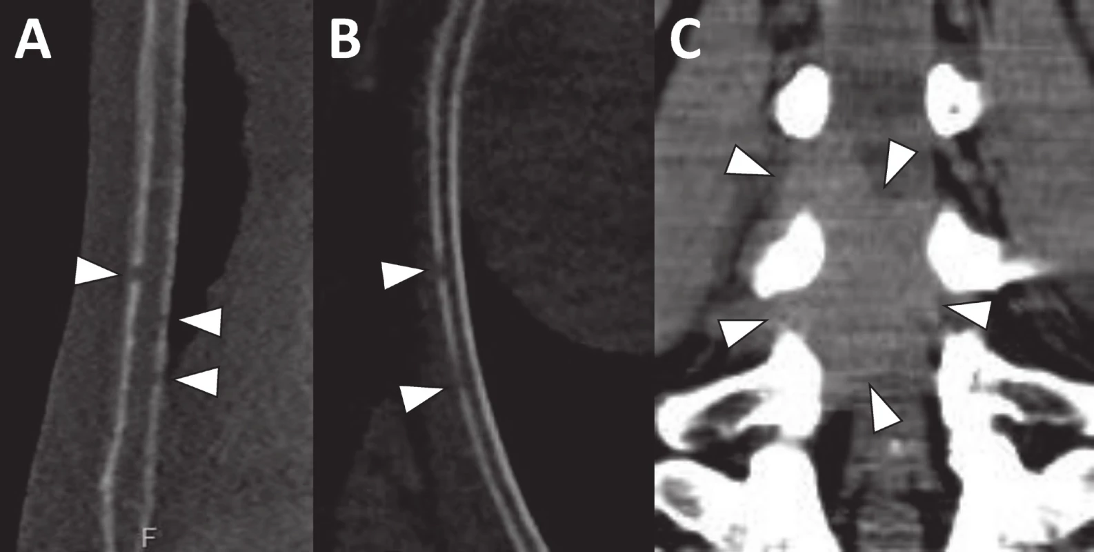Drobná osteolytická ložiska ve sternu (a) a žebru (b) velikosti 1–2 mm jsou díky velkému denzitnímu rozdílu mezi kortikou a měkkou tkání s jistotou detekovatelná i na CT vyšetření provedeném se srovnatelnou radiační zátěží jako RTG
Na CT se rovněž zobrazila měkkotkáňová formace zasahující do páteřního kanálu v bederní oblasti (c).