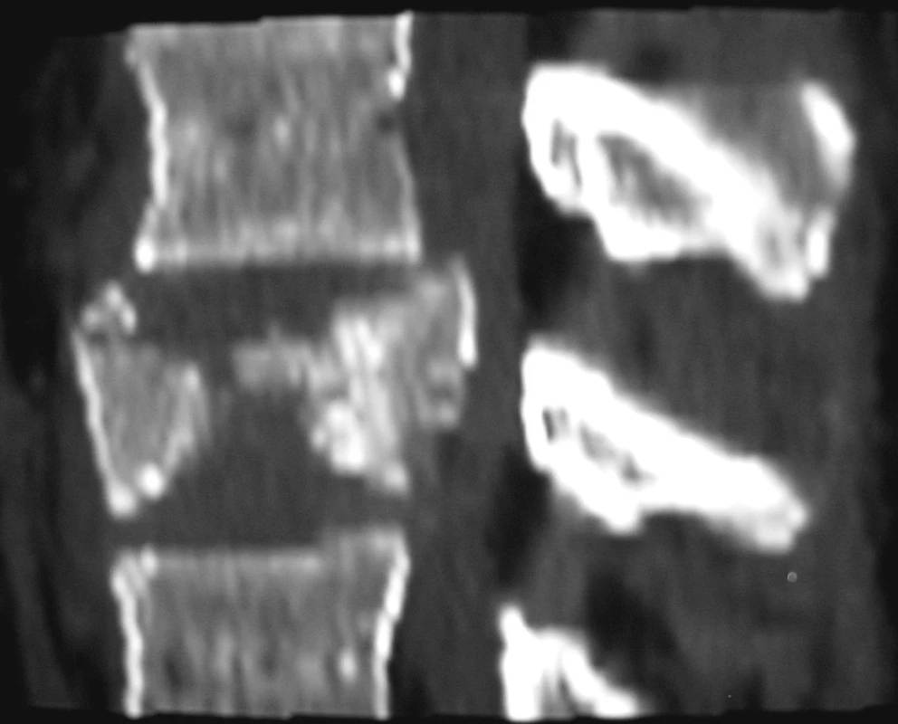 Bočná CT rekonstrukce pincer zlomeniny obratlového těla typ A2.3
Pic. 1. Lateral CT reconstruction of the pincer vertebral body fracture, type A2.3