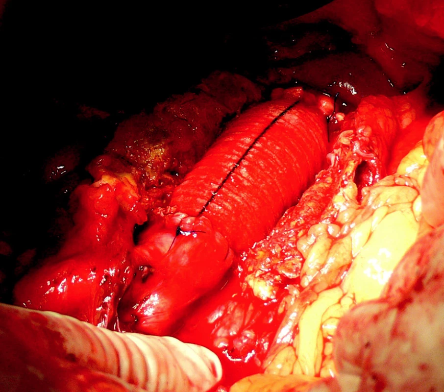 9. Resekce AAA s A-A náhradou ze střední laparotomie
Fig. 9. Resection of the AAA with A-A implantation performed via the midline incision