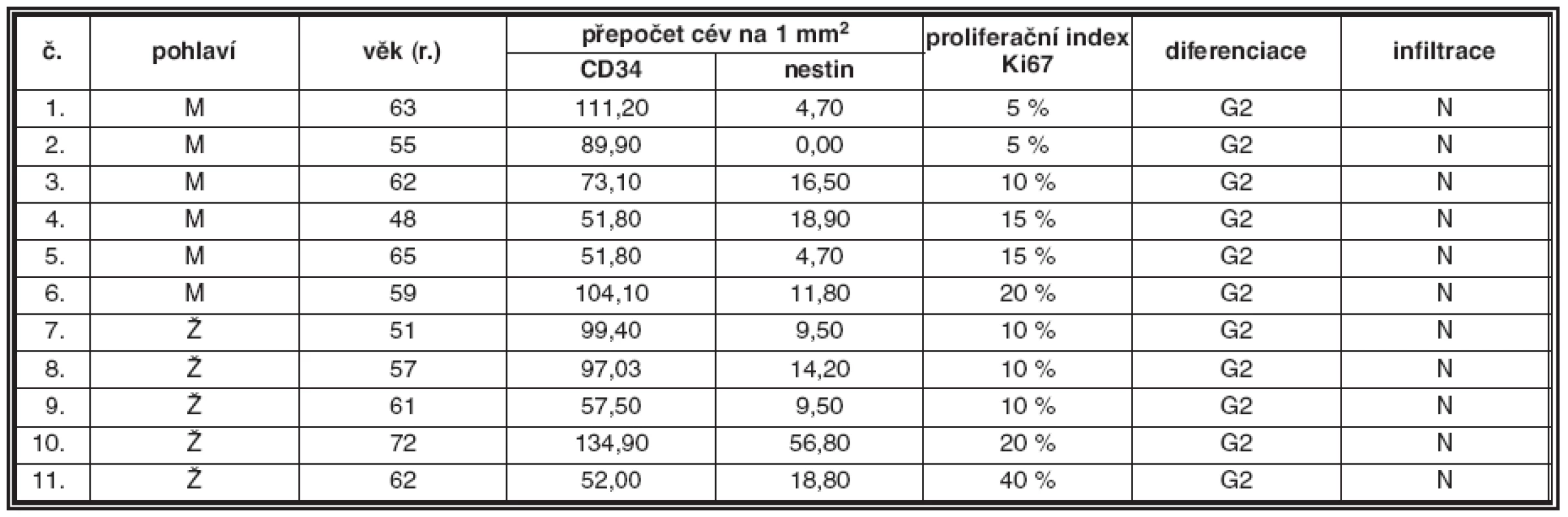 Plazmocytární myelom G2, nodulární infiltrace