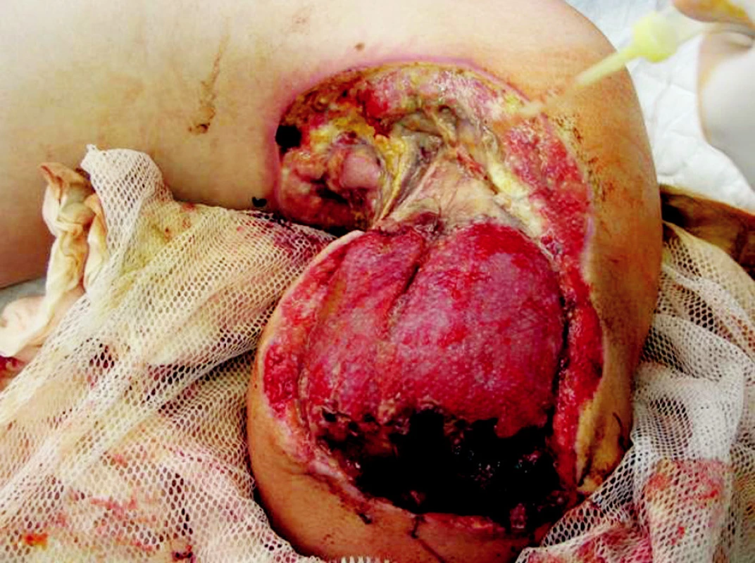 Left arm stump 12th day after the injury – revision in general anesthesia