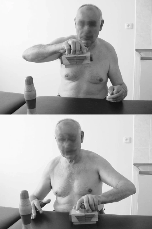Hodnocení jemné motoriky testem TMF.
Legenda: subtest TMF „Zvedání domu dlaňovým úchopem“ - srovnání výkonu pravé a levé ruky. Levou rukou pacient nesvede udržet čtyři díly Domu pohromadě a zvednout objekt. Jsou viditelné asociované pohyby pravé ruky (obr. vpravo).