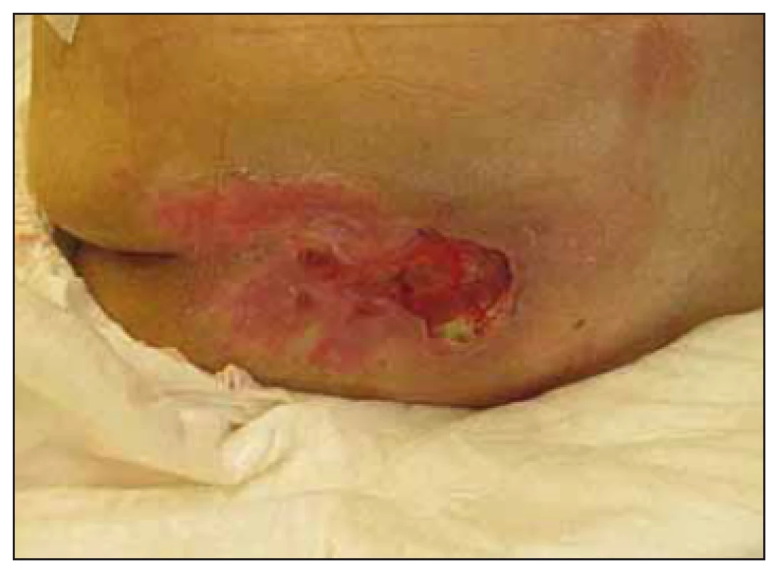 Case study B – significant healing of
pressure ulcer in the sacral region after
6 months of enteral nutrition via percutaneous
endoscopic gastrostomy tubes.<br>
Obr. 5. Klinický prípad B – významné hojenie
dekubitu v sakrálnej oblasti po
šiestich mesiacoch podávania enterálnej
výživy perkutánnou endoskopickou
gastrostómiou.