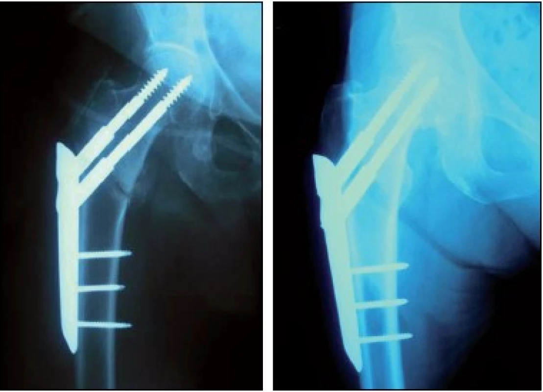 Osteosyntéza vlevo pertrochanterické a vpravo bazicervikální fraktury