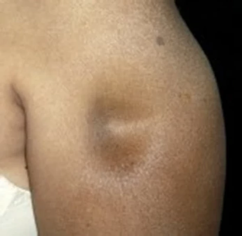 Lupusová panikulitida (LEP) – lupus profundus (převzato z 37)