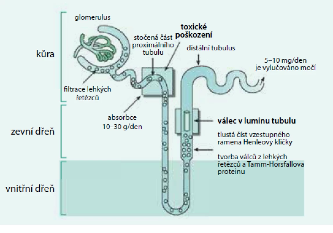 Tubuly poškozují agregáty monoklonálních lehkých řetězců, glomerulární membránu poškozují amyloidová či neamyloidová depozita
Volné lehké řetězce jsou fyziologicky filtrovány v glomerulech a vstřebávány v proximálním tubulu. Při vysoké koncentraci volných lehkých řetězců imunoglobulinů v plazmě procházejí volné lehké řetězce do distálních částí nefronu, v němž dochází ke koncentraci moči, k precipitaci těchto lehkých řetězců a ke tvorbě odlitkových válců. To závažně poškodí funkci ledvin. V močovém sedimentu pak lze nalézt zvýšené množství hyalinních válců a zvýšený odpad bílkoviny za 24 hodin. Elektroforézou lze v moči prokázat lehké řetězce jako tzv. Bence Jonesovu bílkovinu.